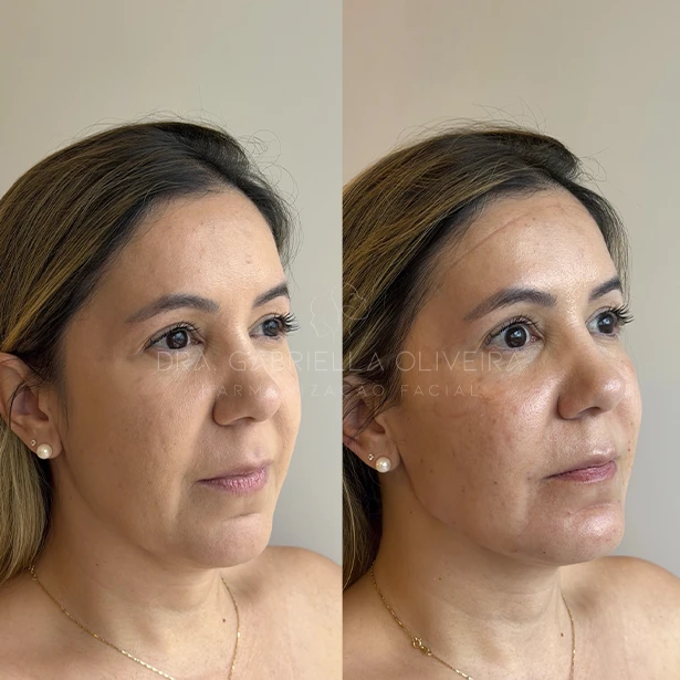 ANTES 10 - DRA GABRIELLA OLIVEIRA