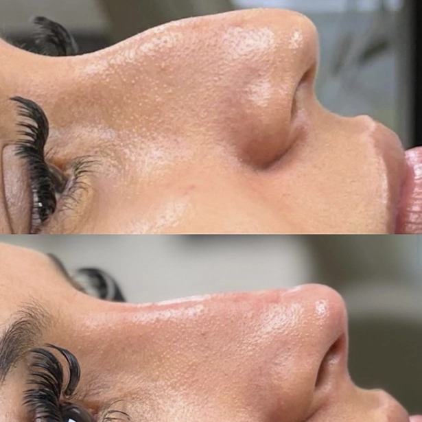 ANTES E DEPOIS 4 - DRA GABRIELLA